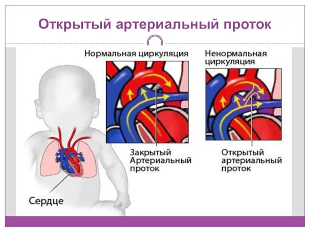 Открытый артериальный проток