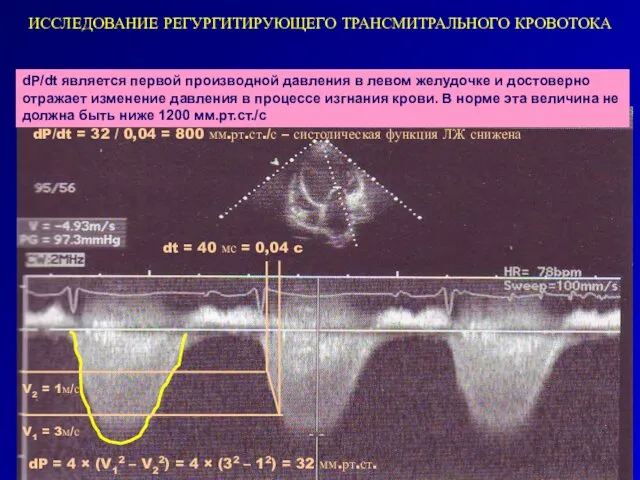 ИССЛЕДОВАНИЕ РЕГУРГИТИРУЮЩЕГО ТРАНСМИТРАЛЬНОГО КРОВОТОКА dP/dt является первой производной давления в