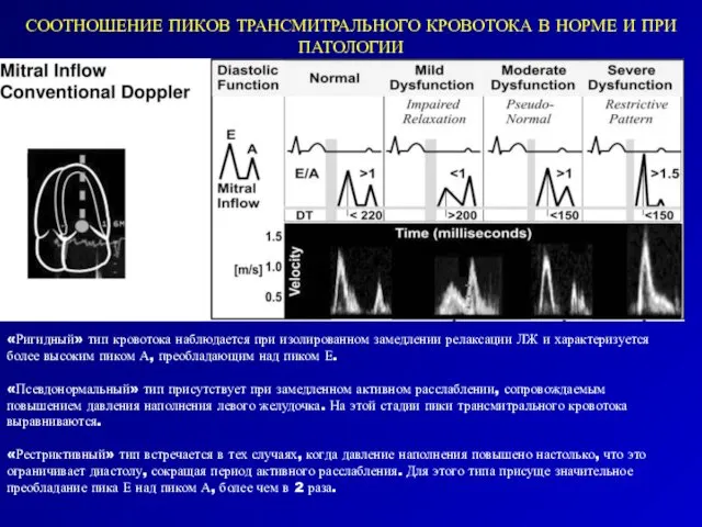 СООТНОШЕНИЕ ПИКОВ ТРАНСМИТРАЛЬНОГО КРОВОТОКА В НОРМЕ И ПРИ ПАТОЛОГИИ «Ригидный»