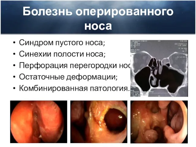 Болезнь оперированного носа Синдром пустого носа; Синехии полости носа; Перфорация перегородки носа; Остаточные деформации; Комбинированная патология.