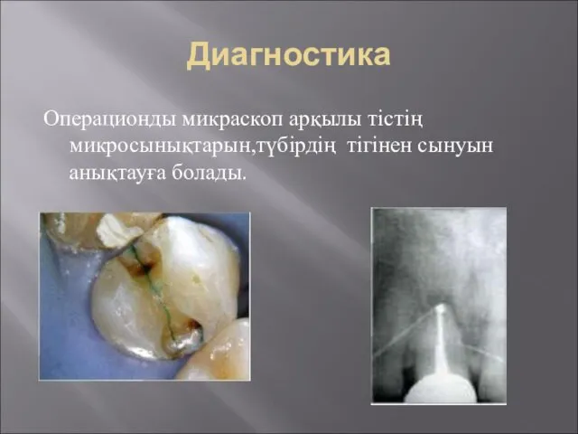 Диагностика Операционды микраскоп арқылы тістің микросынықтарын,түбірдің тігінен сынуын анықтауға болады.