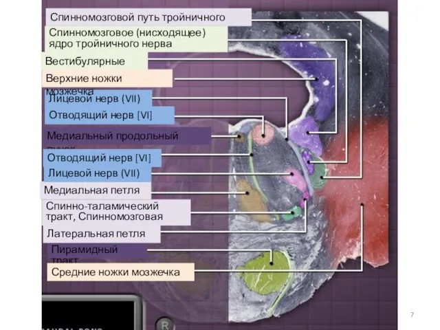 Спинно-таламический тракт, Спинномозговая петля Спинномозговой путь тройничного нерва Медиальный продольный