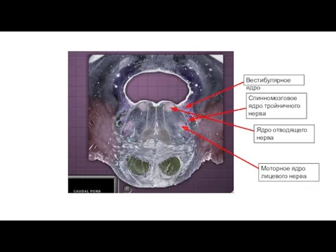 Вестибулярное ядро Ядро отводящего нерва Моторное ядро лицевого нерва Спинномозговое ядро тройничного нерва