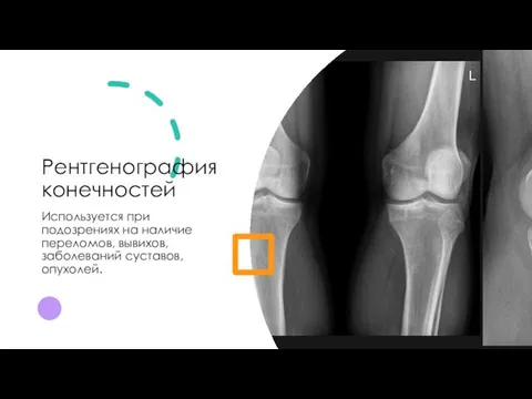 Рентгенография конечностей Используется при подозрениях на наличие переломов, вывихов, заболеваний суставов, опухолей.