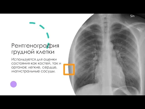 Рентгенография грудной клетки Используется для оценки состояния как костей, так и органов: легкие, сердце, магистральные сосуды.