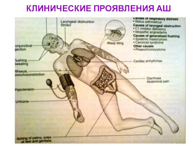 КЛИНИЧЕСКИЕ ПРОЯВЛЕНИЯ АШ