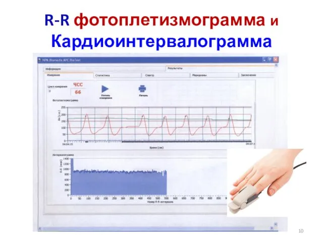 R-R фотоплетизмограмма и Кардиоинтервалограмма