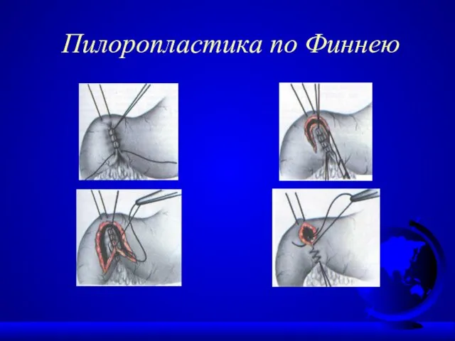 Пилоропластика по Финнею