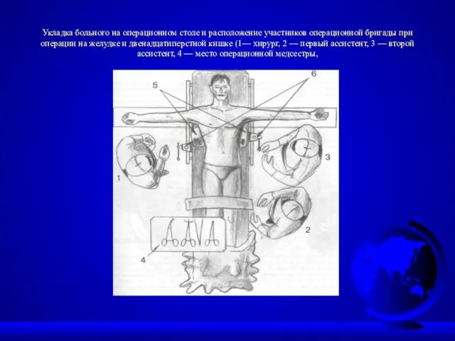 Укладка больного на операционном столе и расположение участников операцион­ной бригады при операции на