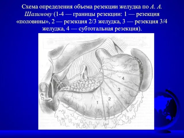 Схема определения объема резекции желудка по А. А. Шалимову (1-4