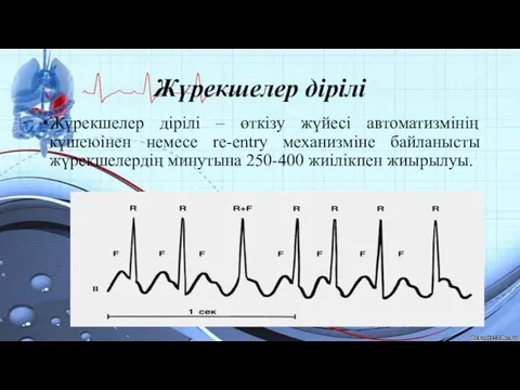 Жүрекшелер дірілі Жүрекшелер дірілі – өткізу жүйесі автоматизмінің күшеюінен немесе