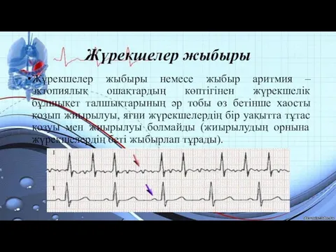 Жүрекшелер жыбыры Жүрекшелер жыбыры немесе жыбыр аритмия – эктопиялық ошақтардың