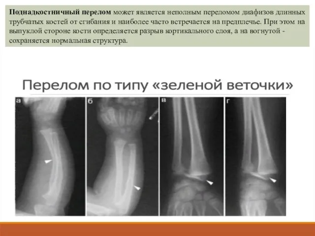 Поднадкостничный перелом может является неполным переломом диафизов длинных трубчатых костей