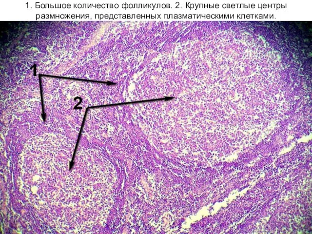 1. Большое количество фолликулов. 2. Крупные светлые центры размножения, представленных плазматическими клетками.