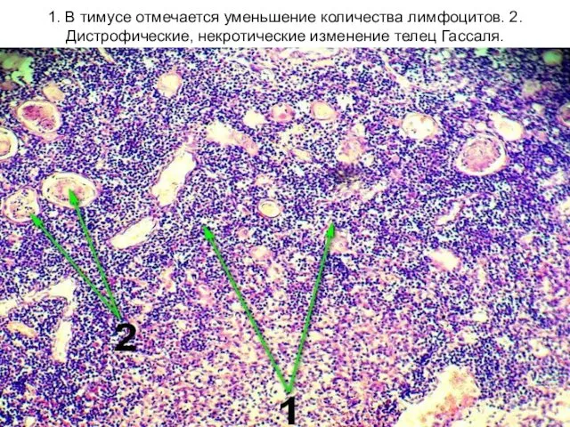 1. В тимусе отмечается уменьшение количества лимфоцитов. 2. Дистрофические, некротические изменение телец Гассаля.