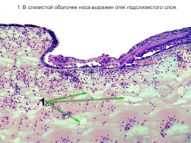 1. В слизистой оболочке носа выражен отек подслизистого слоя.