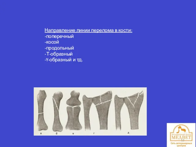 Направление линии перелома в кости: -поперечный -косой -продольный -Т-образный -Y-образный и тд.