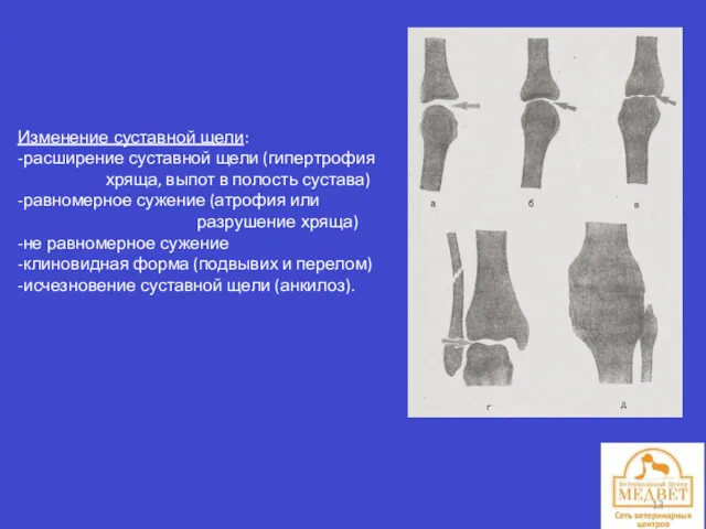 Изменение суставной щели: -расширение суставной щели (гипертрофия хряща, выпот в