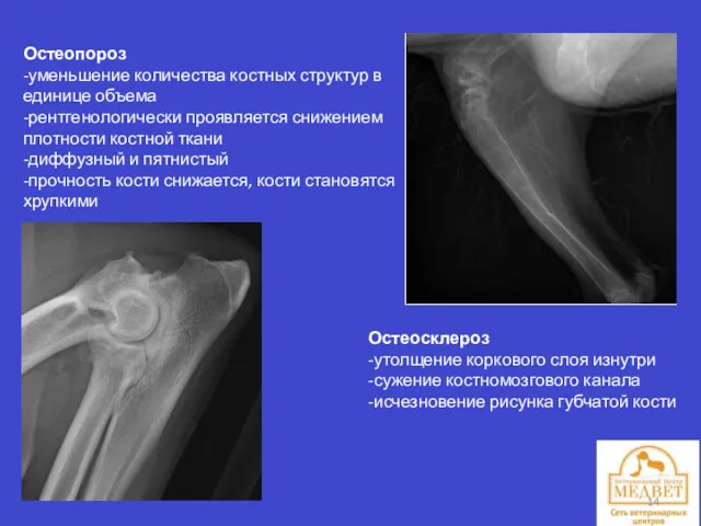 Остеопороз -уменьшение количества костных структур в единице объема -рентгенологически проявляется