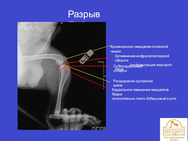 Разрыв ПКС Краниальное смещение коленной чашки Затемнение инфрапателлярной области (инфильтрация