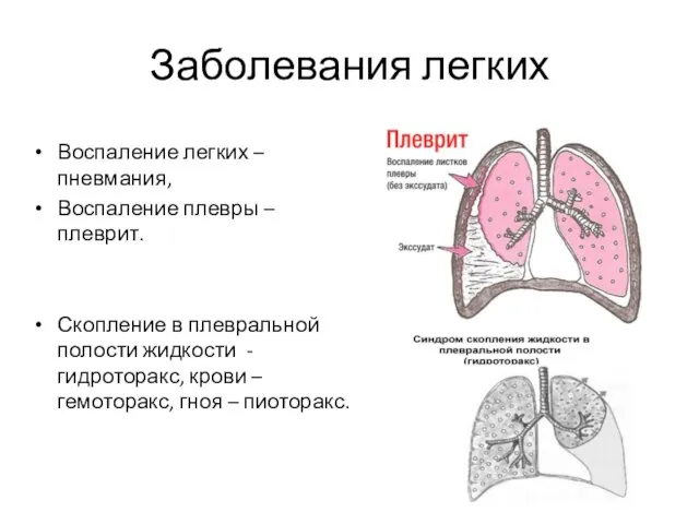 Заболевания легких Воспаление легких – пневмания, Воспаление плевры – плеврит.