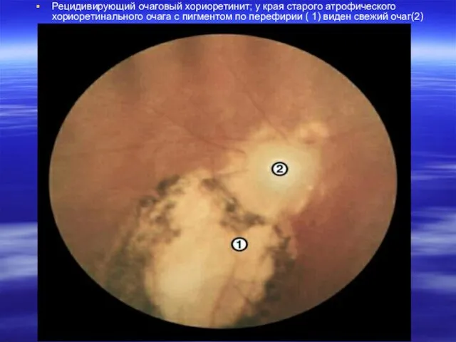 Рецидивирующий очаговый хориоретинит; у края старого атрофического хориоретинального очага с