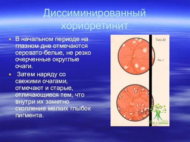 Диссиминированный хориоретинит В начальном периоде на глазном дне отмечаются серовато-белые,