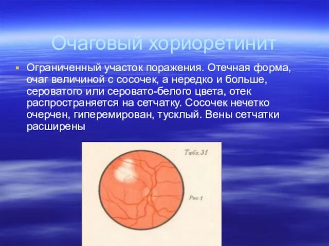 Очаговый хориоретинит Ограниченный участок поражения. Отечная форма, очаг величиной с