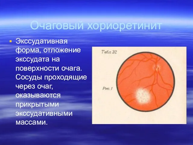 Очаговый хориоретинит Экссудативная форма, отложение экссудата на поверхности очага. Сосуды