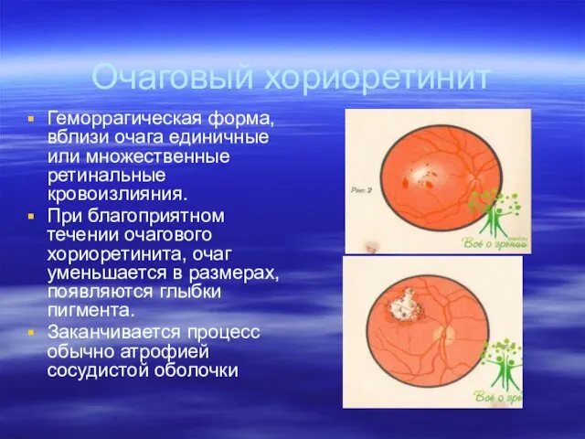 Очаговый хориоретинит Геморрагическая форма, вблизи очага единичные или множественные ретинальные