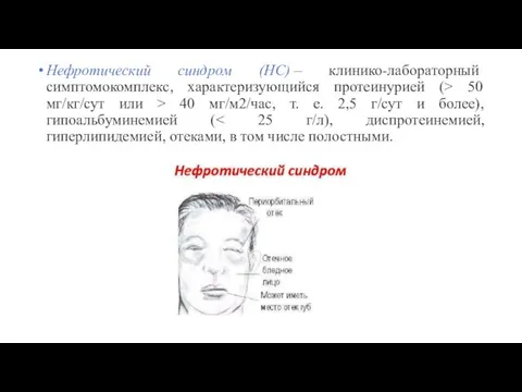 Нефротический синдром (НС) – клинико-лабораторный симптомокомплекс, характеризующийся протеинурией (> 50