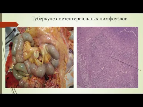 Туберкулез мезентериальных лимфоузлов