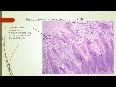Язык, окраска гематоксилин эозин, х 10. Гиперкератоз – чрезмерное утолщение рогового (ортокератинового) слоя эпителия.