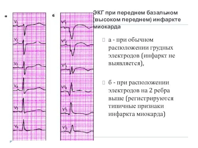 ЭКГ при переднем базальном (высоком переднем) инфаркте миокарда а - при обычном расположении