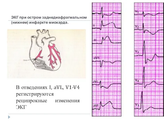 ЭКГ при остром заднедиафрагмальном (нижнем) инфаркте миокарда. В отведениях I, aVL, V1-V4 регистрируются реципрокные изменения ЭКГ
