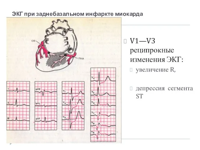 ЭКГ при заднебазальном инфаркте миокарда V1—V3 реципрокные изменения ЭКГ: увеличение R, депрессия сегмента ST