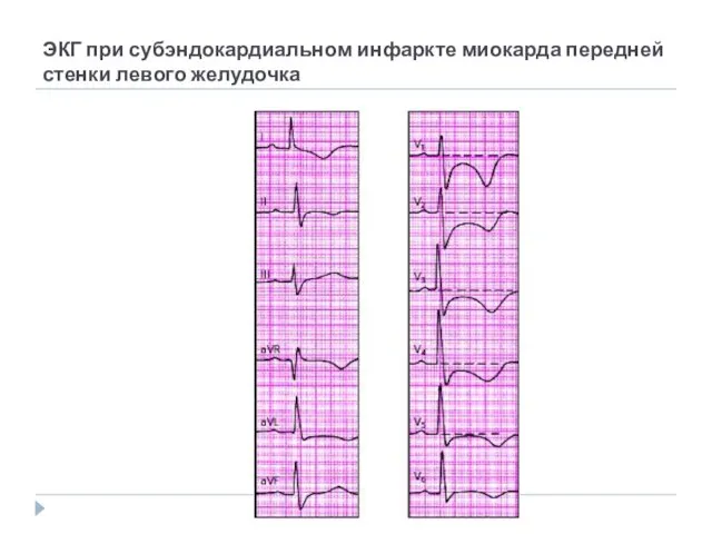 ЭКГ при субэндокардиальном инфаркте миокарда передней стенки левого желудочка
