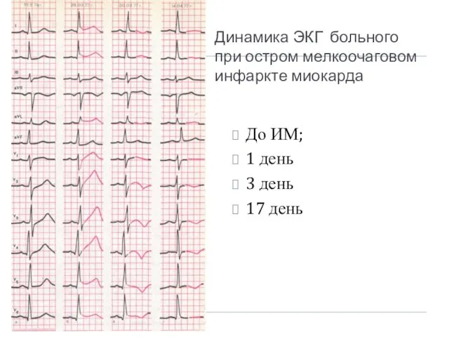 Динамика ЭКГ больного при остром мелкоочаговом инфаркте миокарда До ИМ; 1 день 3 день 17 день