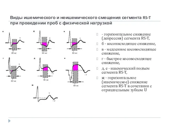 Виды ишемического и неишемического смещения сегмента RS-T при проведении проб с физической нагрузкой