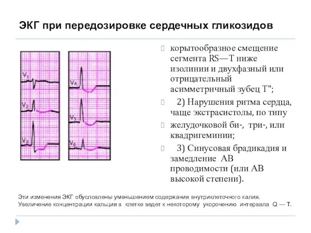 ЭКГ при передозировке сердечных гликозидов корытообразное смещение сегмента RS—Т ниже изолинии и двухфазный