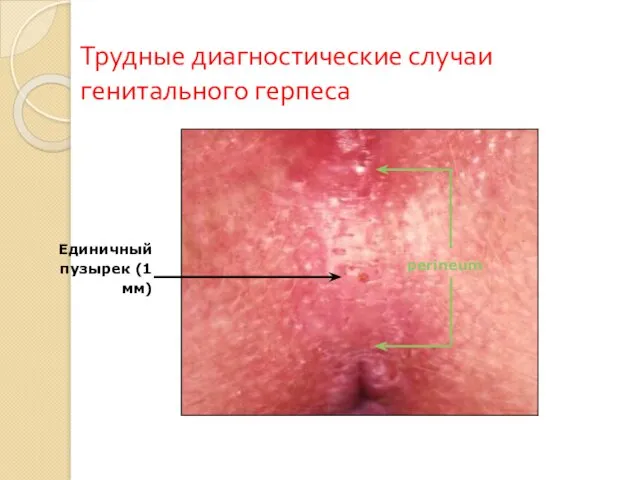 perineum Трудные диагностические случаи генитального герпеса Единичный пузырек (1 мм)