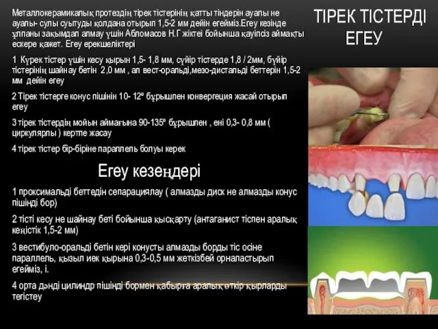 ТІРЕК ТІСТЕРДІ ЕГЕУ Металлокерамикалық протездің тірек тістерінің қатты тіндерін ауалы