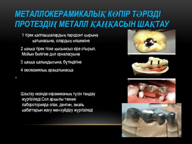 МЕТАЛЛОКЕРАМИКАЛЫҚ КӨПІР ТӘРІЗДІ ПРОТЕЗДІҢ МЕТАЛЛ ҚАҢҚАСЫН ШАҚТАУ 1 тірек қалпақшалардың