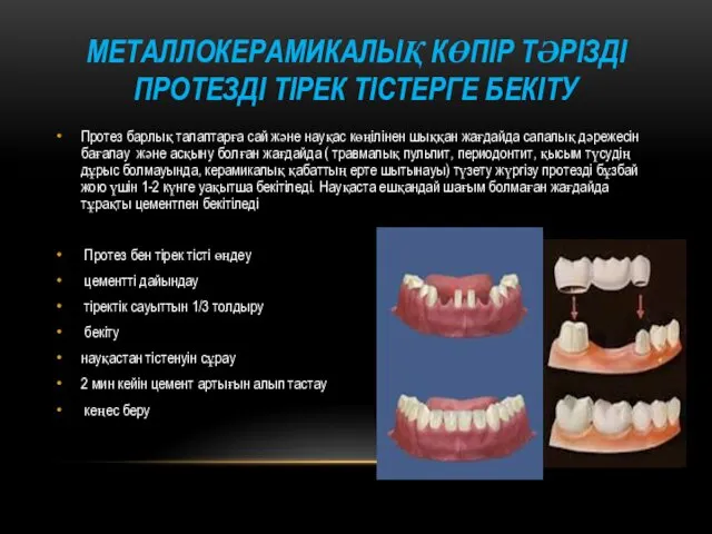 МЕТАЛЛОКЕРАМИКАЛЫҚ КӨПІР ТӘРІЗДІ ПРОТЕЗДІ ТІРЕК ТІСТЕРГЕ БЕКІТУ Протез барлық талаптарға