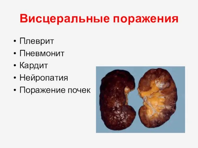 Висцеральные поражения Плеврит Пневмонит Кардит Нейропатия Поражение почек