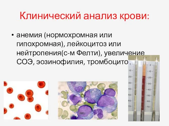 Клинический анализ крови: анемия (нормохромная или гипохромная), лейкоцитоз или нейтропения(с-м Фелти), увеличение СОЭ, эозинофилия, тромбоцитоз.