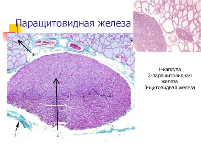 Паращитовидная железа 1-капсула 2-паращитовидная железа 3-щитовидная железа