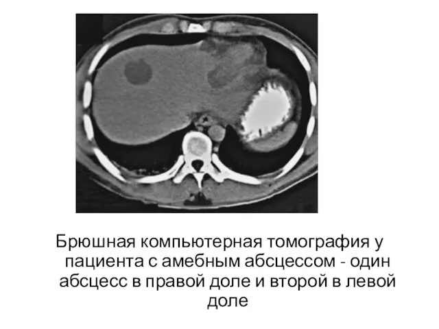 Брюшная компьютерная томография у пациента с амебным абсцессом - один