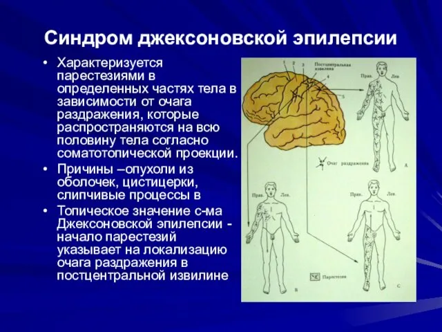 Синдром джексоновской эпилепсии Характеризуется парестезиями в определенных частях тела в