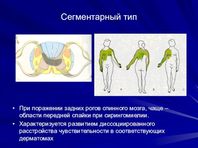 Сегментарный тип При поражении задних рогов спинного мозга, чаще – области передней спайки